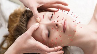 What are the Benefits of Acupuncture Therapy ?