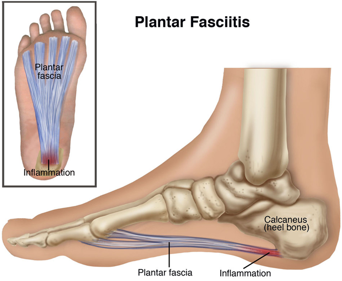 Physiotherapy Treatment for Plantar Fasciitis