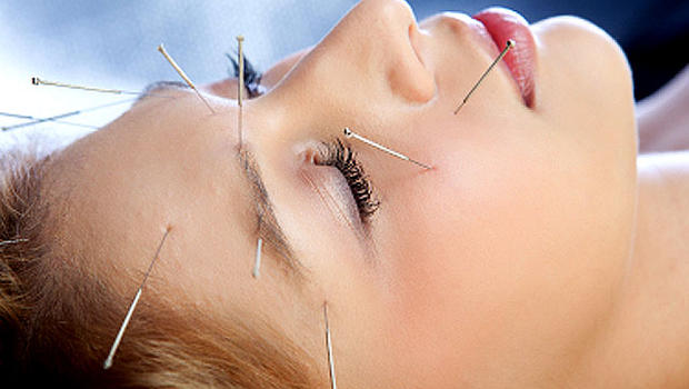 What are the Benefits of Acupuncture Therapy ?