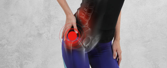 Piriformis Syndrome Massage Treatment