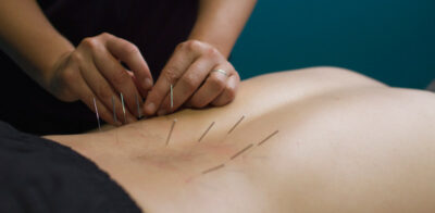 Dry needling vs. acupuncture