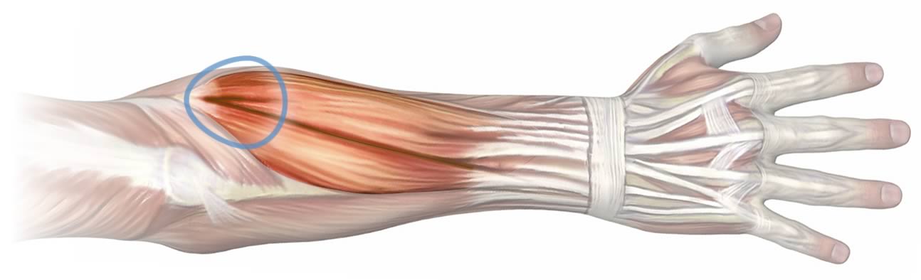 What Is Forearm Tendonitis