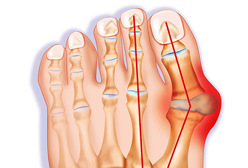Bunions: Best Home Remedies